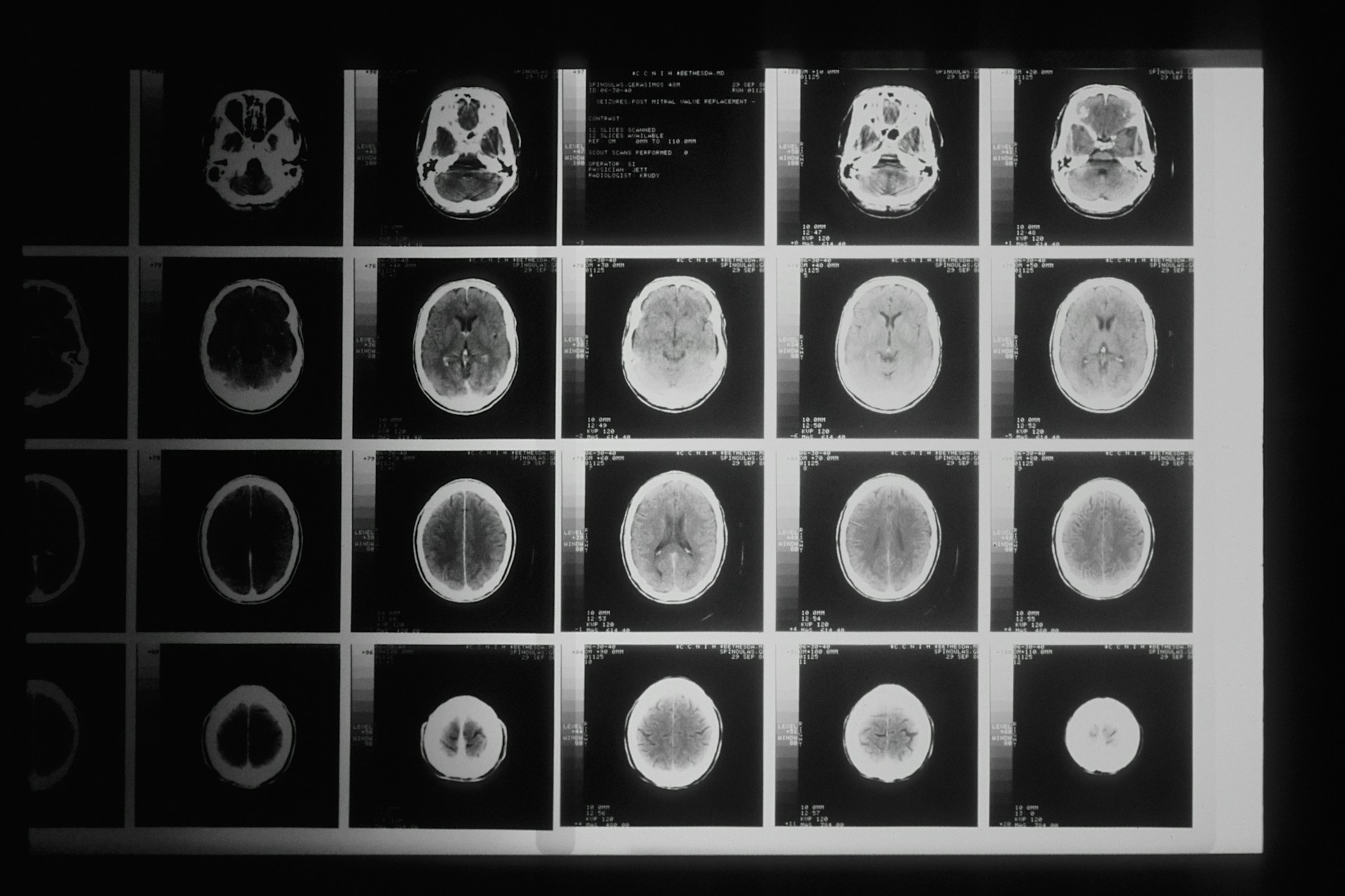 Tumor